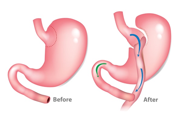 Stomach before and after gastric bypass