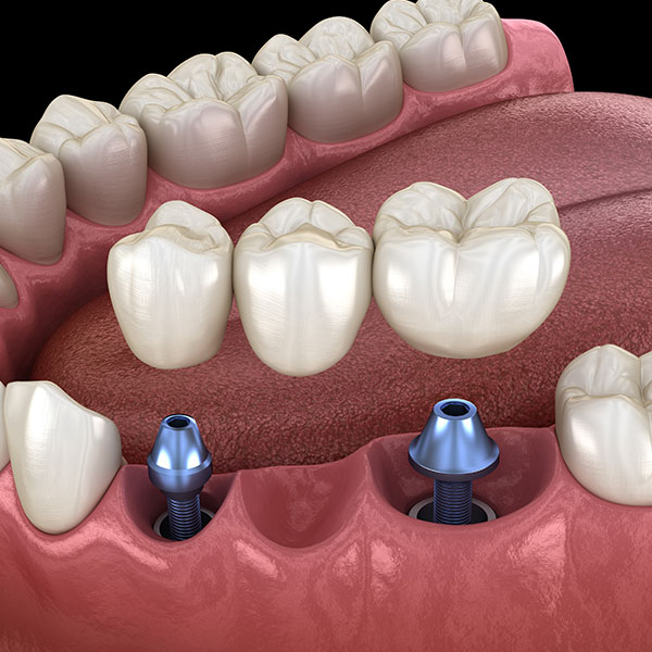 implant-supported dental bridge