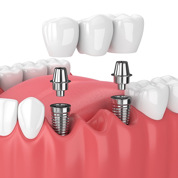 Implant bridge