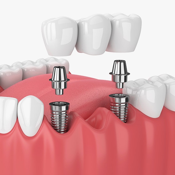 Implant-Supported Bridge pieces