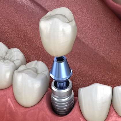 Dental Implant Illustration