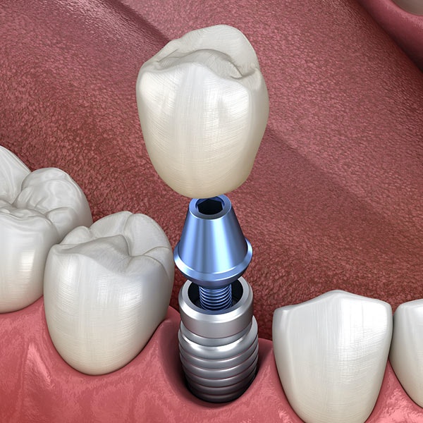 Illustration of dental implant