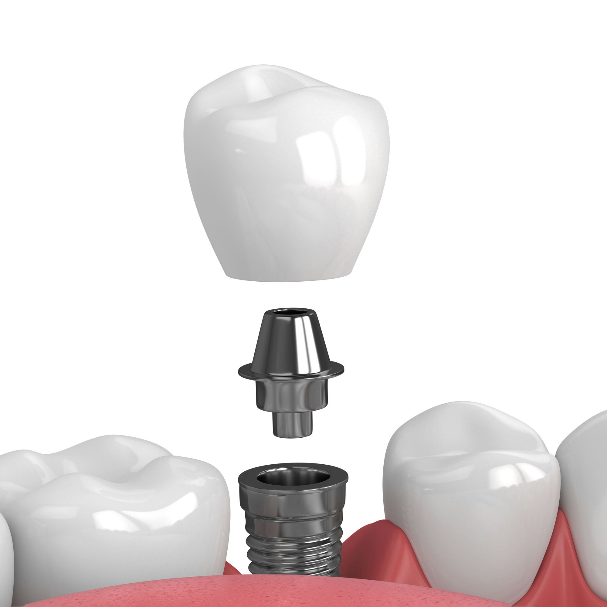 dental implant