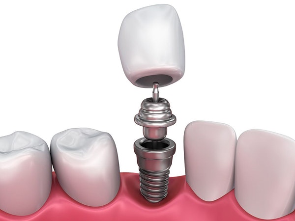 an implant-supported crown