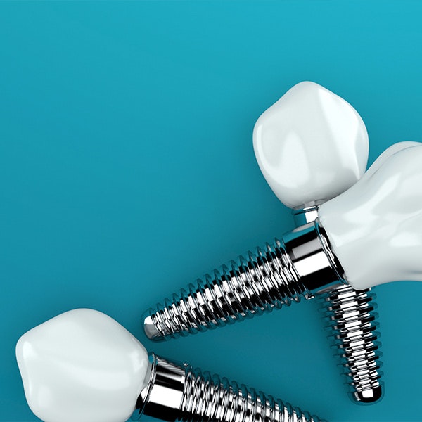 Illustration of dental implants