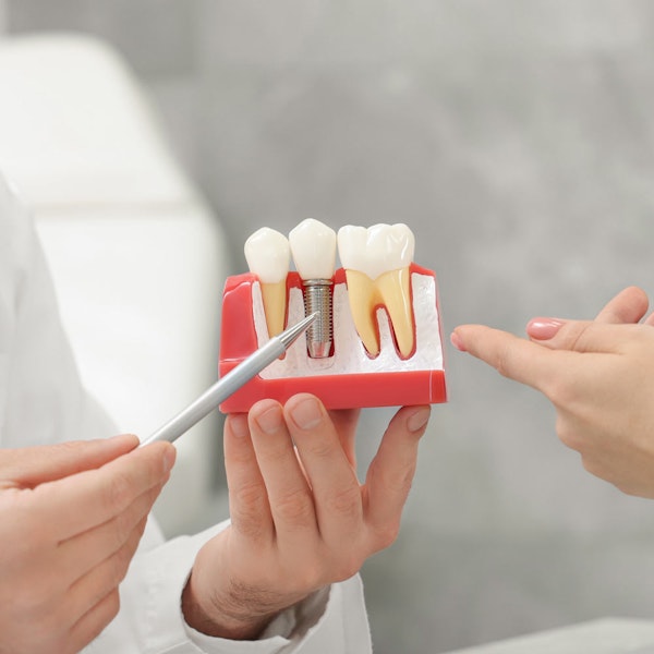 Dental implant model