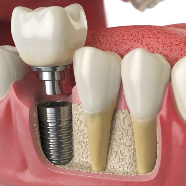 dental implant
