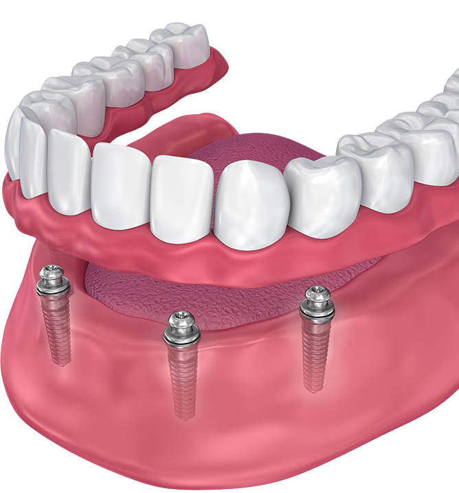 implant-supported denture