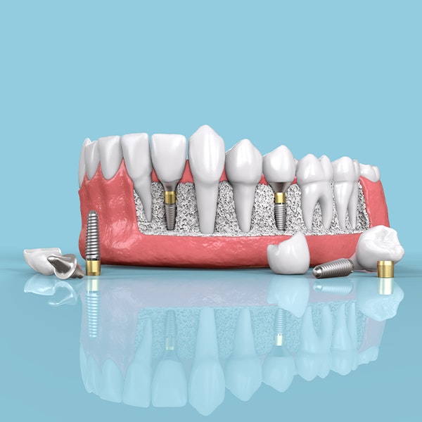 3D model of a jaw with dental implants