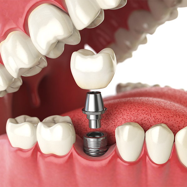Dental Implants