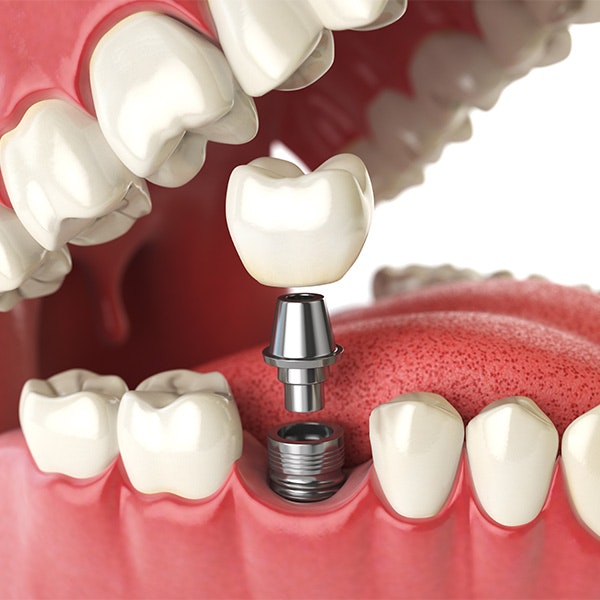 Dental Implants