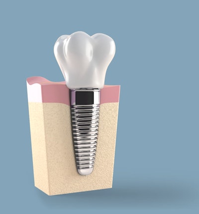 Implant Crowns