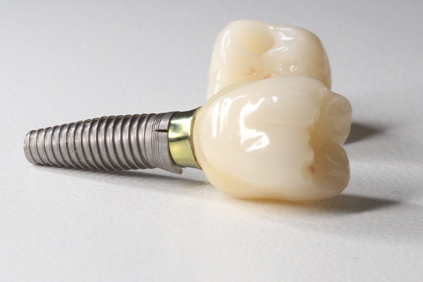 implant-supported crown