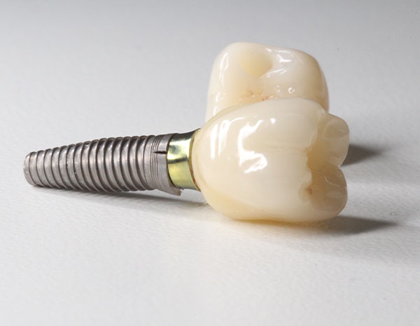 Dental Implants