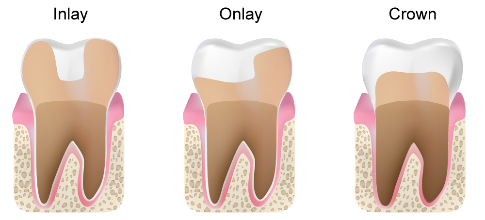 Réparez vos dents : couronne dentaire ou prothèse dentaire sur