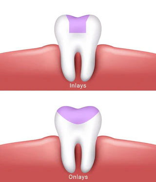 Atlante Inlay Inlays and Onlays - Loveland, CO - West Lake Dental