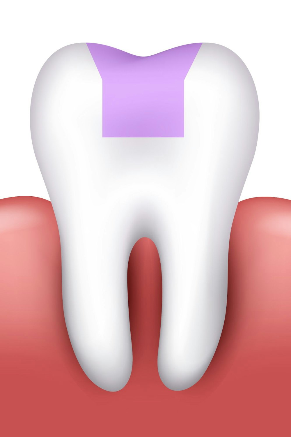 Illustration of inlays and onlays