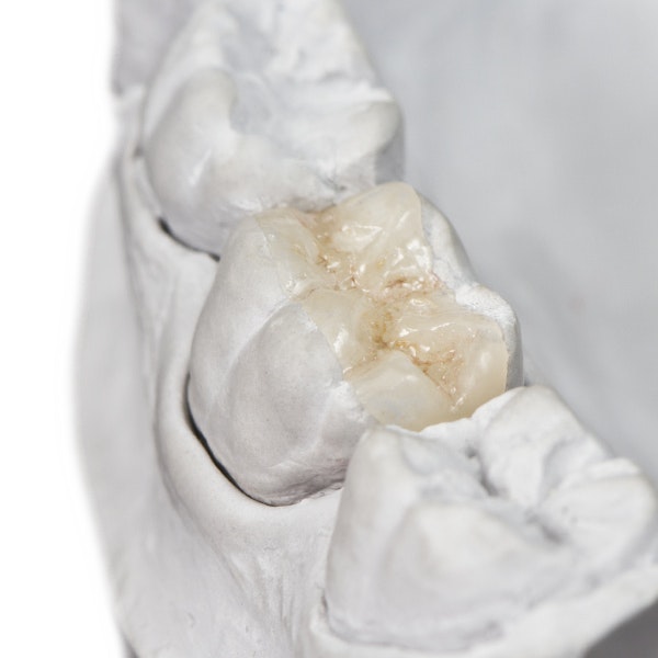 Inlay on teeth mould