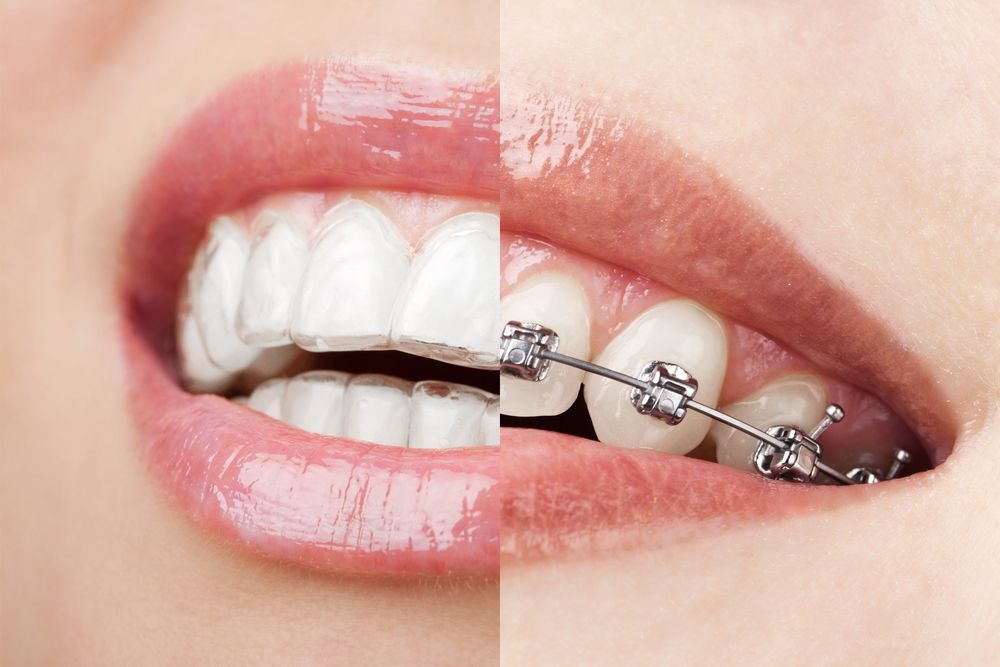 Invisalign and braces