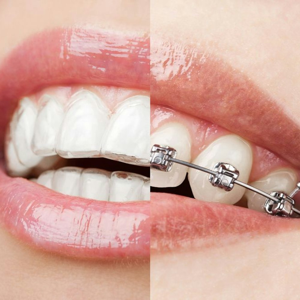 Invisalign vs. braces