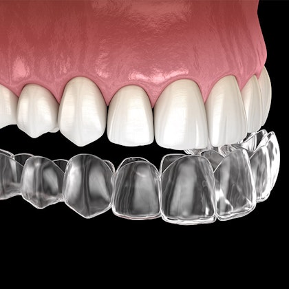 Invisalign aligners