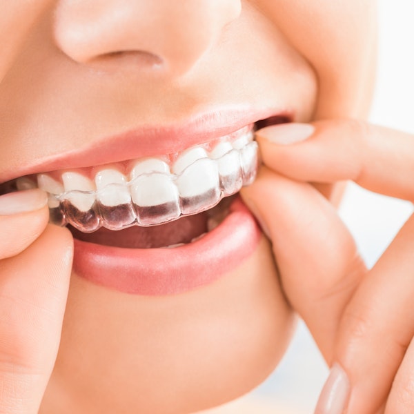 A patient with an Invisalign aligner