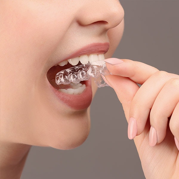 Patient putting on Invisalign tray