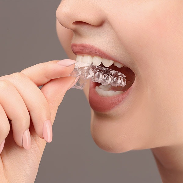 removing clear aligner