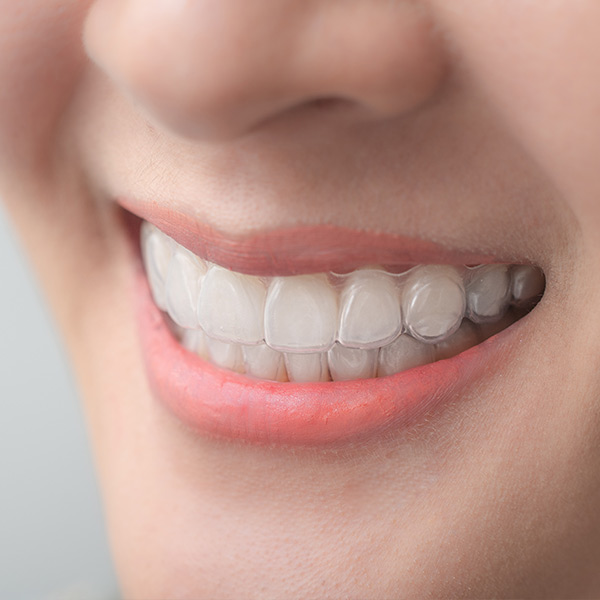 What Is an Overbite? - Bordentown Braces