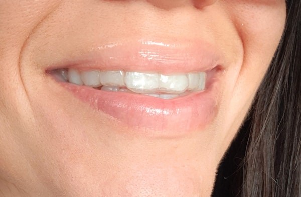 Woman wearing Invisalign
