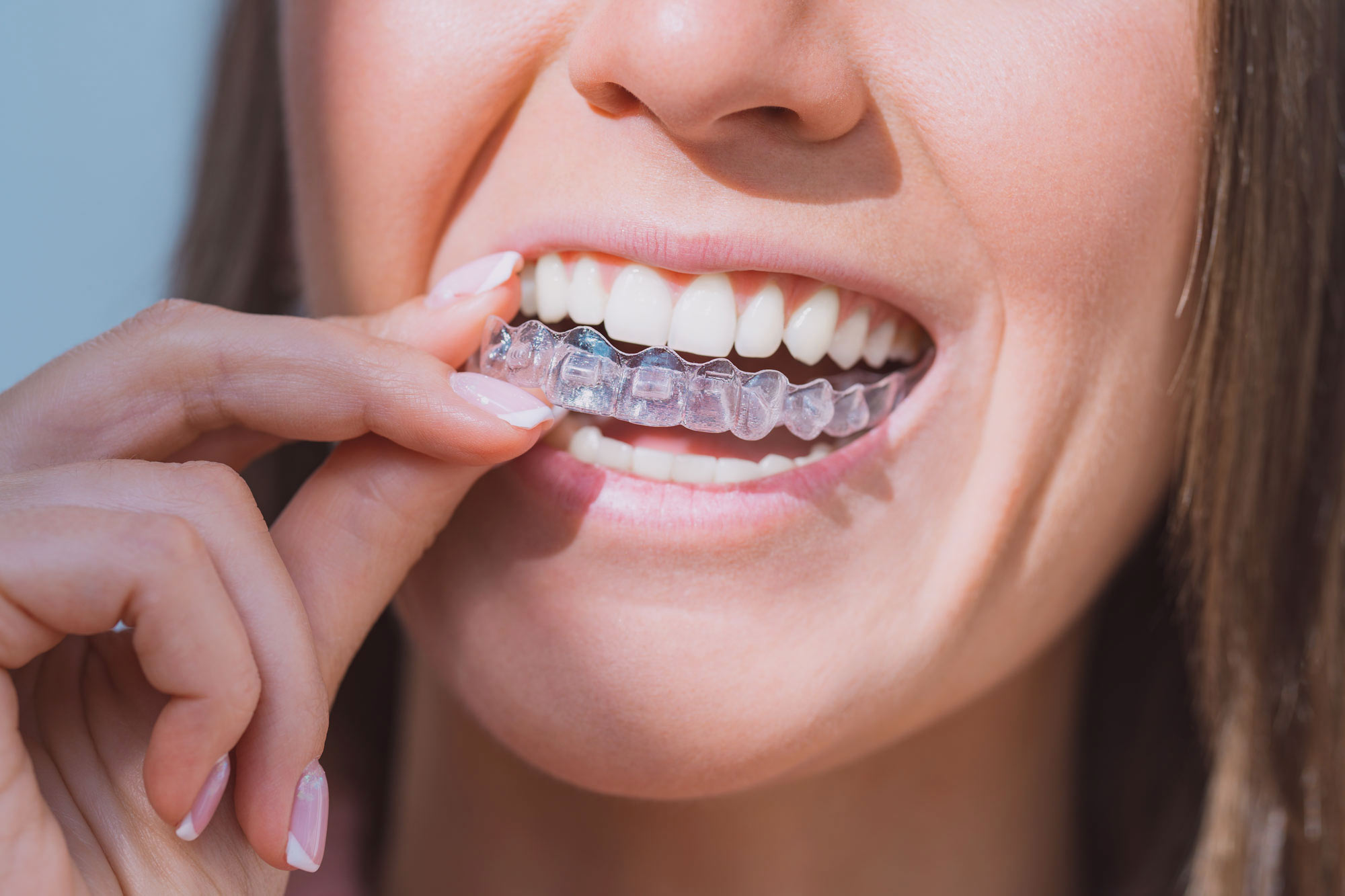 Tooth-Friendly Tips: Dealing with Sharp Invisalign Attachments