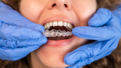 Orthodontist putting on Invisalign