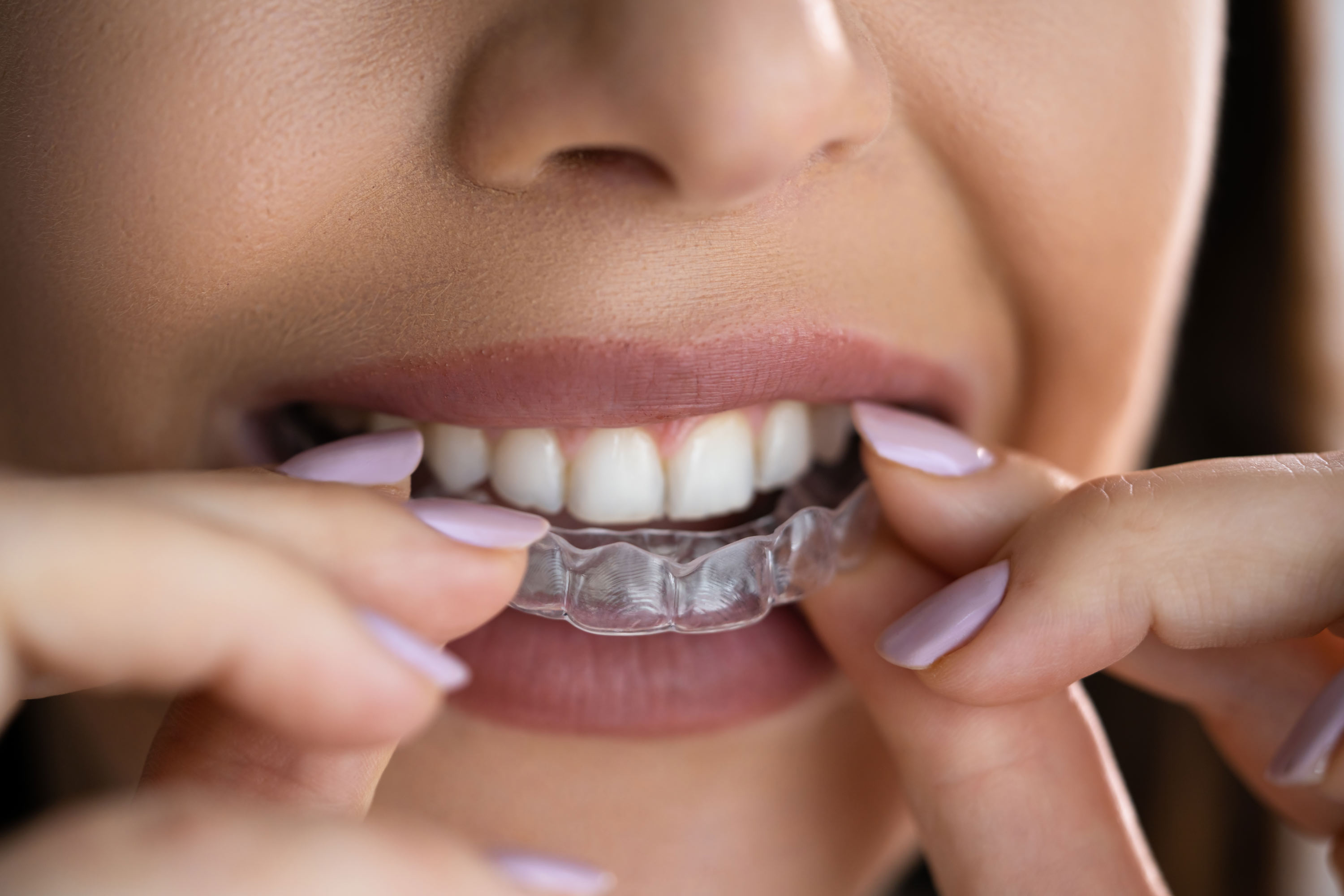Invisalign over teeth