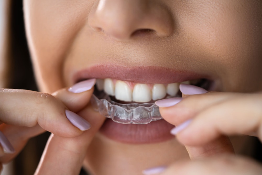 Invisalign aligner tray put into man's mouth