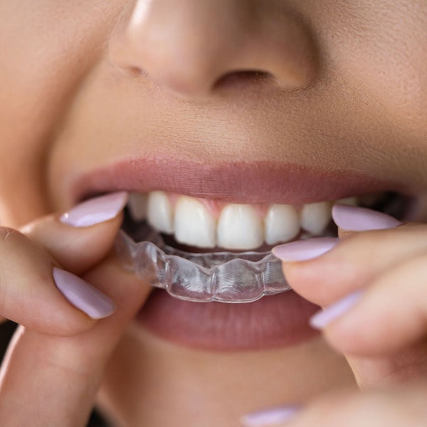 Invisalign over teeth