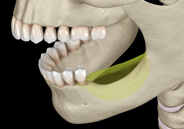 Illustration of bone loss in jaw