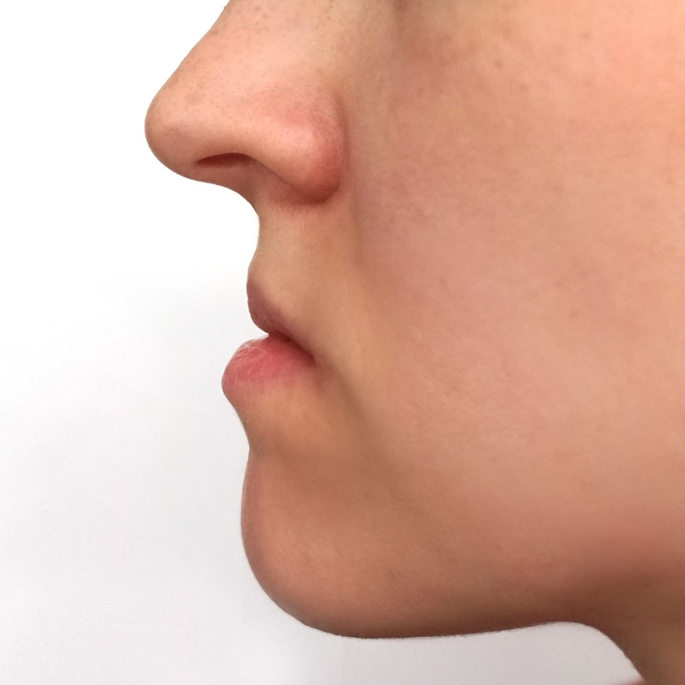Before jaw surgery