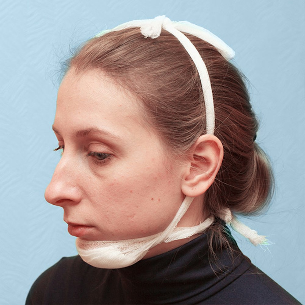 Jaw Surgery