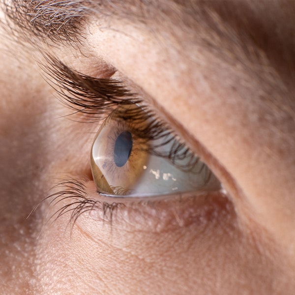 Person with severe keratoconus