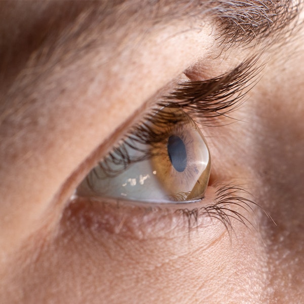 Close up of thinning cornea