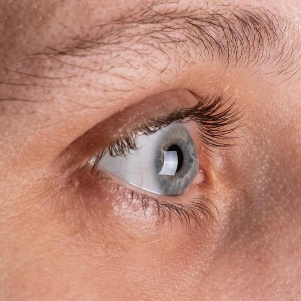 Close up of woman in need of corneal transplantation