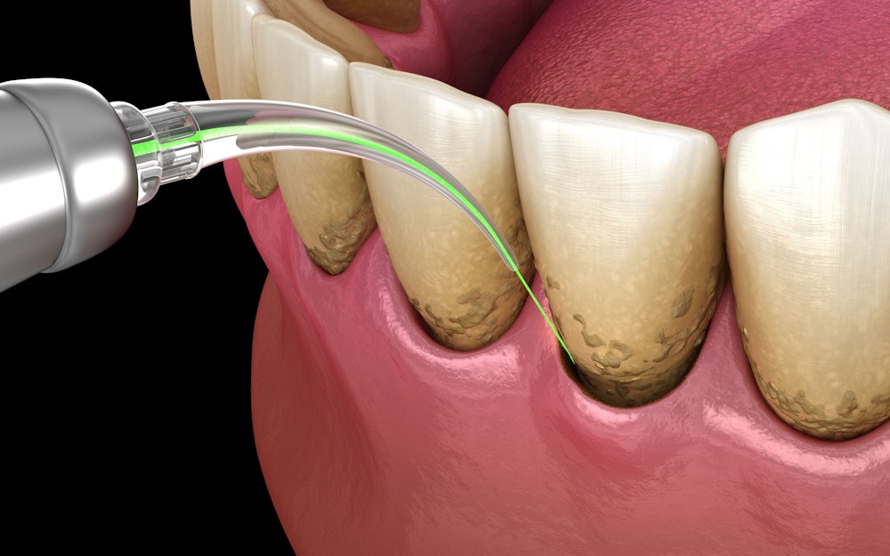 Laser Dentistry Illustration
