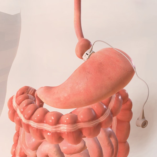 LAP Band Gastric Surgery