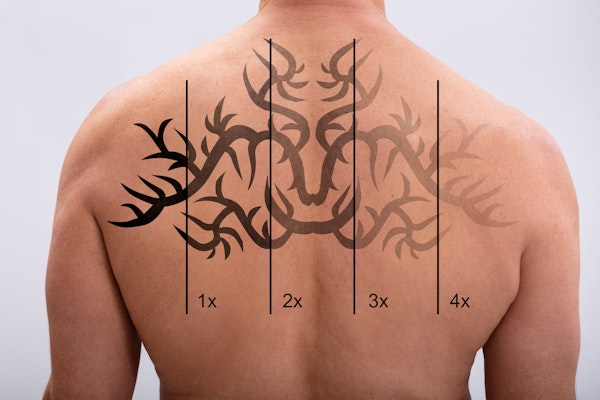 Laser Tattoo Removal Lubbock TX - Unwanted Tattoo Removal Lubbock TX