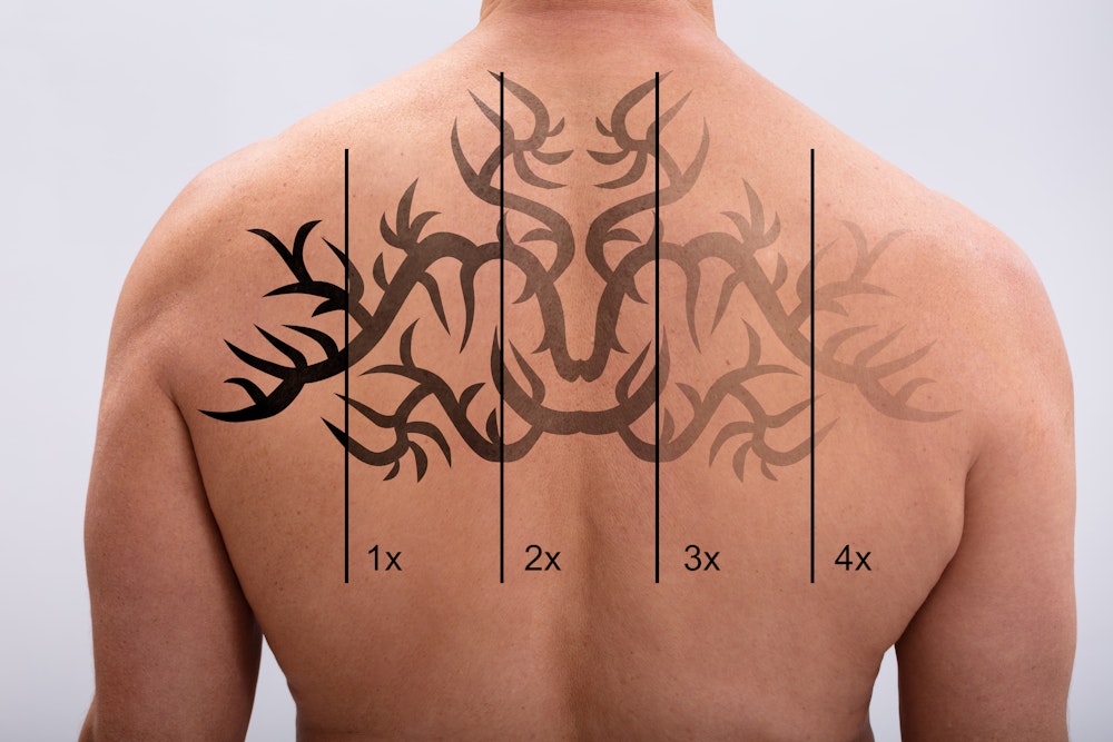 a back tattoo progressively lightened after a series of laser tattoo removal sessions