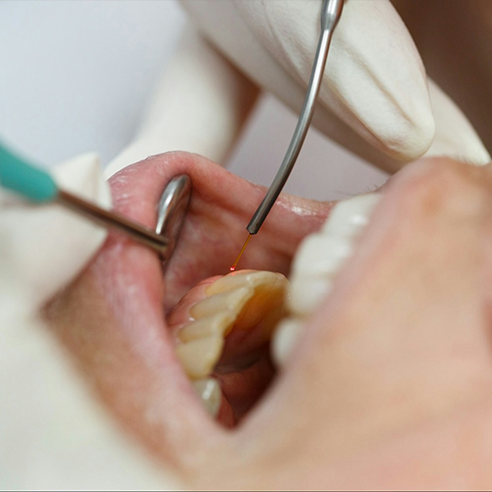 Laser gum disease treatment