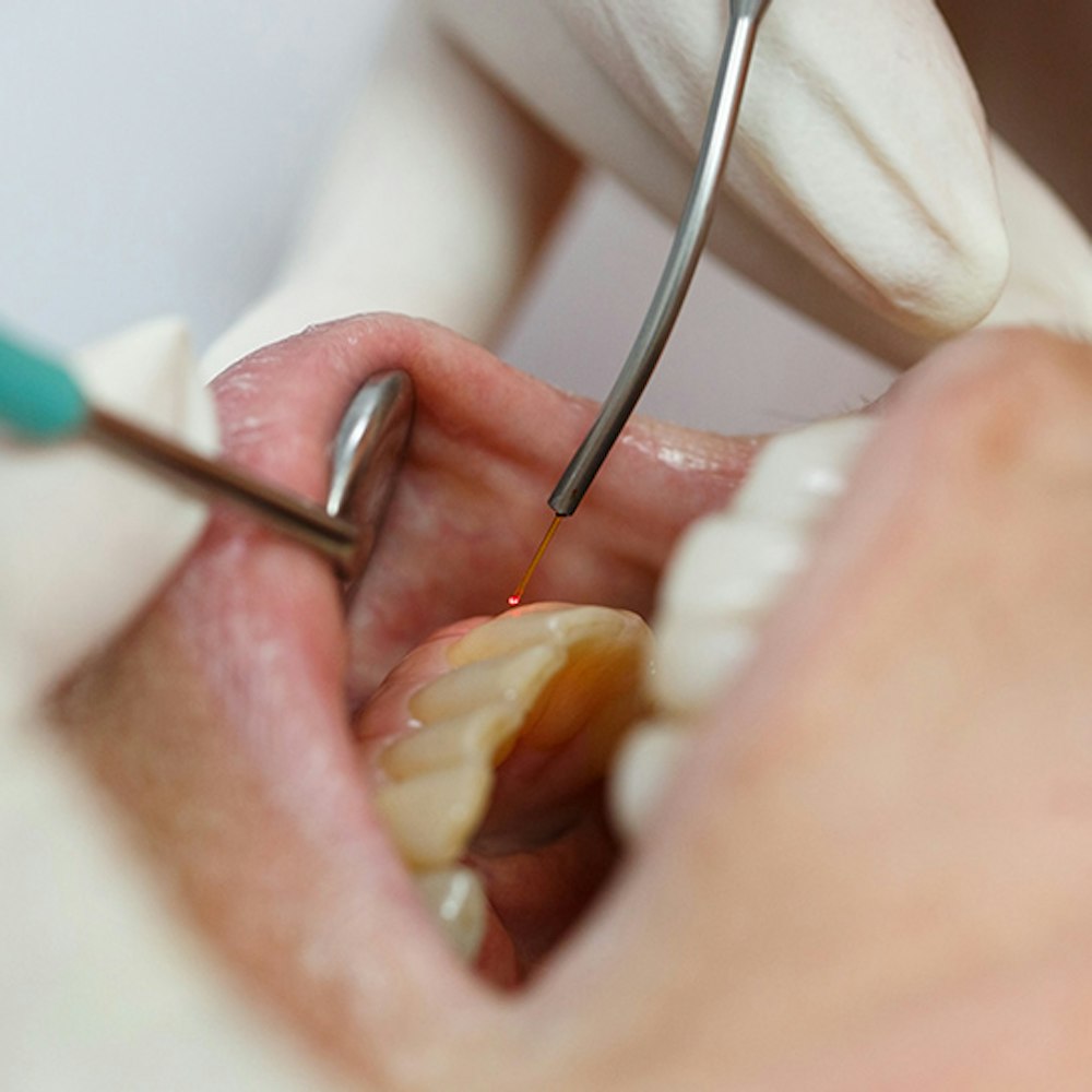 gum tissue laser