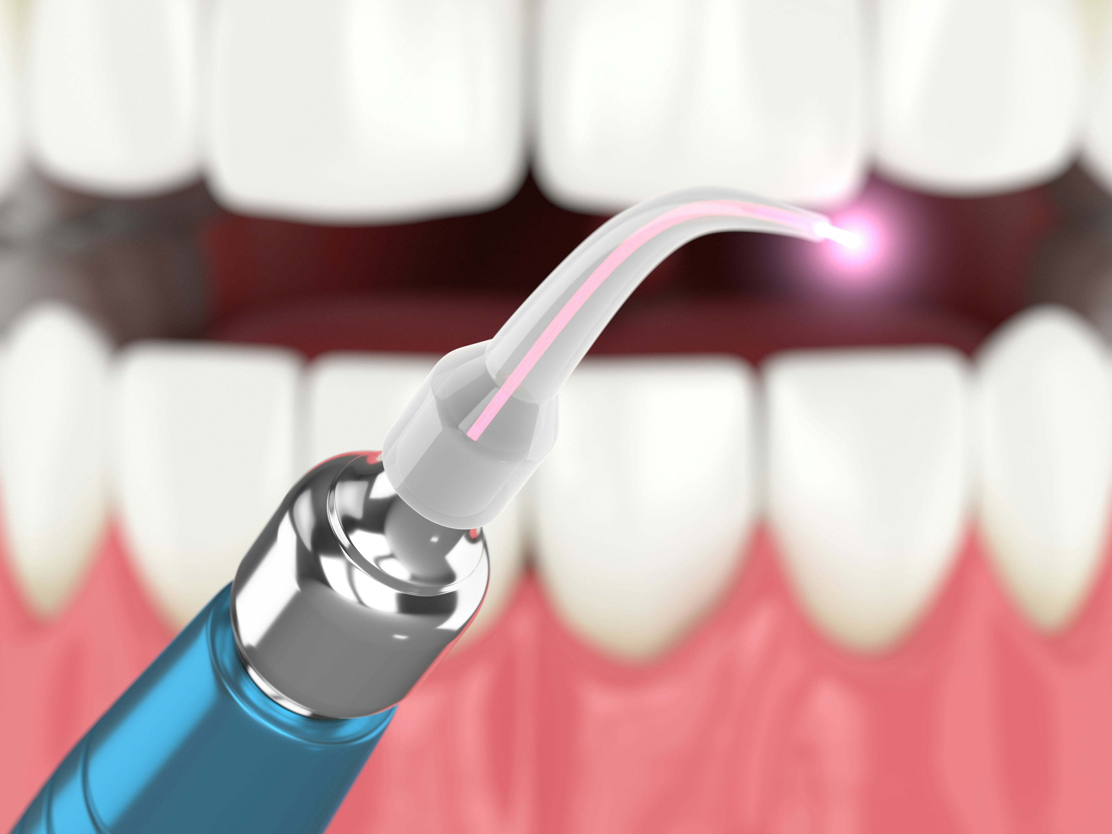 Illustration of laser in front of teeth