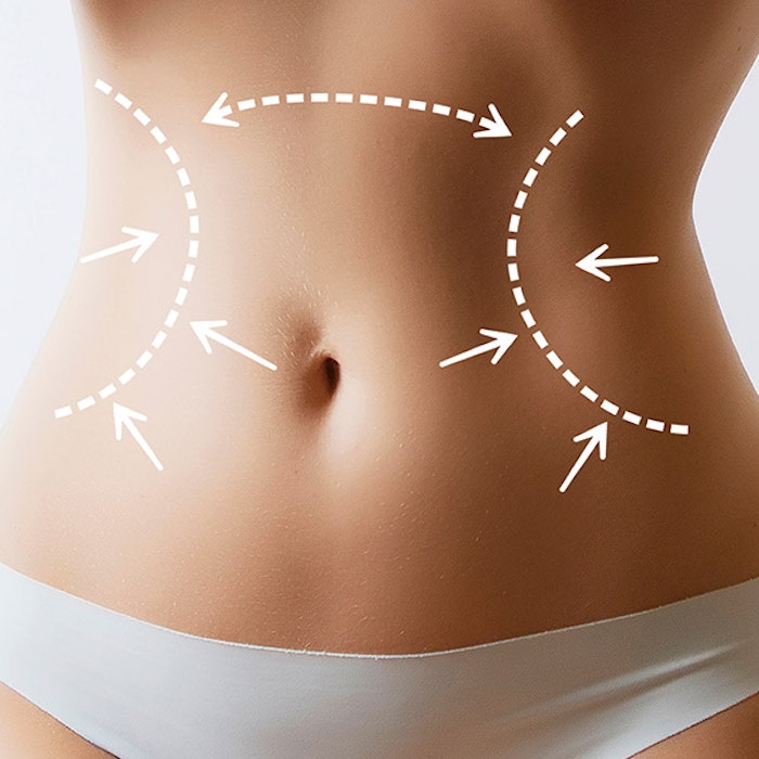 stomach with liposuction target areas highlighted
