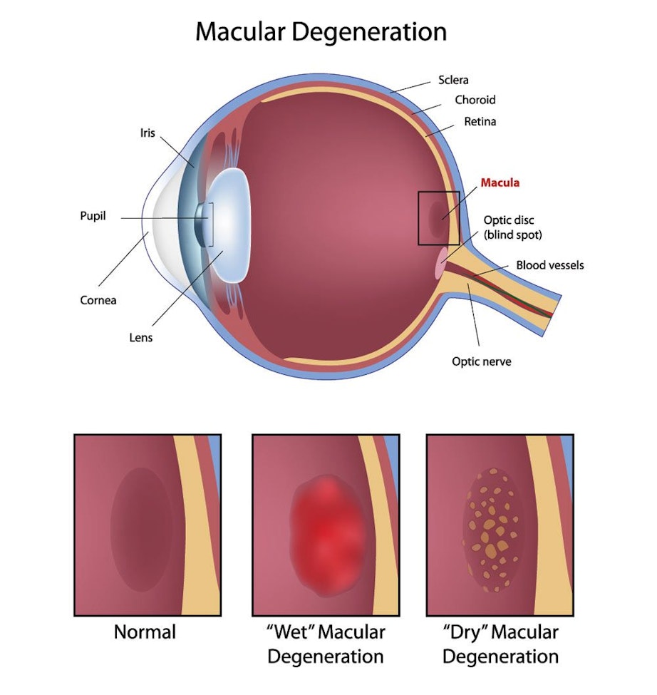 Illustration of macular degeneration in the eye (positions of the macula, optic disc (blind spot), blood vessels, optic nerve, lens, cornea, pupil, iris, sclera, choroid, retina). Three boxes that show a normal macula, "wet" macular degeneration, "dry" macular degeneration